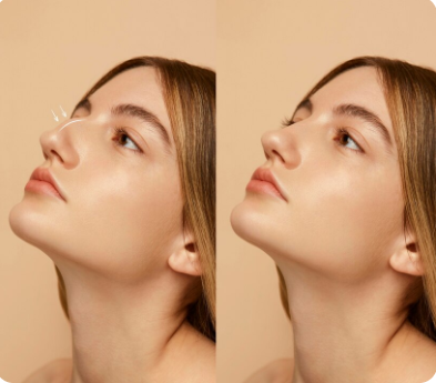Antes y despues rinoplastia 1